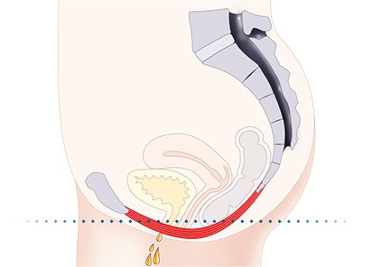 Pelvic-Floor Muscle Repair 5 Pelvic floor muscles Thames Ditton
